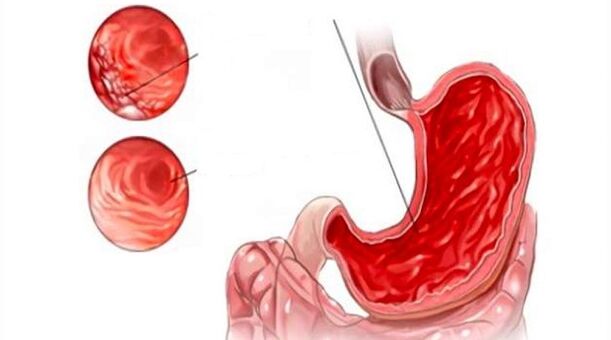 damage to the gastric mucosa when consuming alcohol