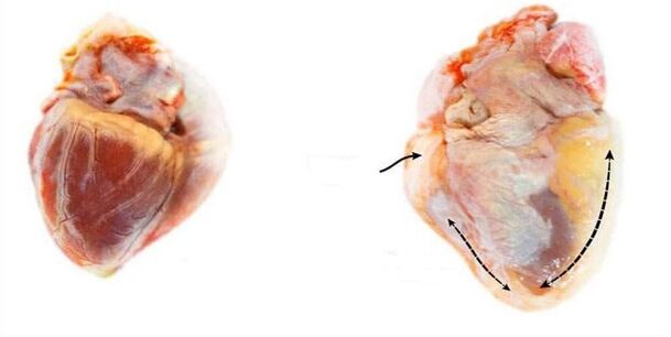 healthy and alcohol-affected heart