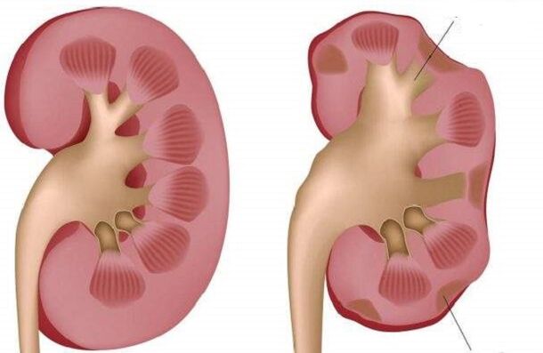 healthy and sick kidneys when consuming alcohol