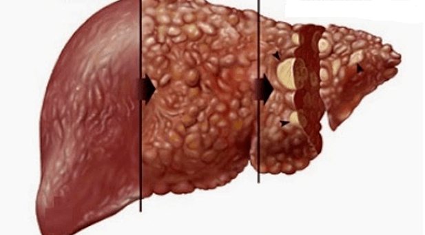 the harmful effects of alcohol on the human liver